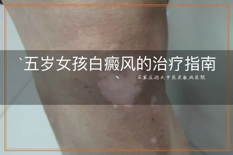 五岁女孩白癜风的治疗指南