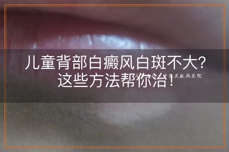儿童背部白癜风白斑不大？这些方法帮你治！