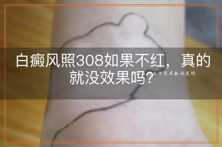 白癜风照308如果不红，真的就没效果吗？