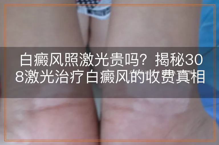白癜风照激光贵吗？揭秘308激光治疗白癜风的收费真相