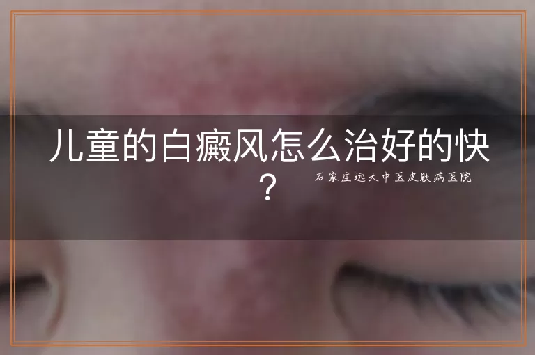 儿童的白癜风怎么治好的快？