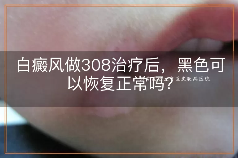 白癜风做308治疗后，黑色可以恢复正常吗？