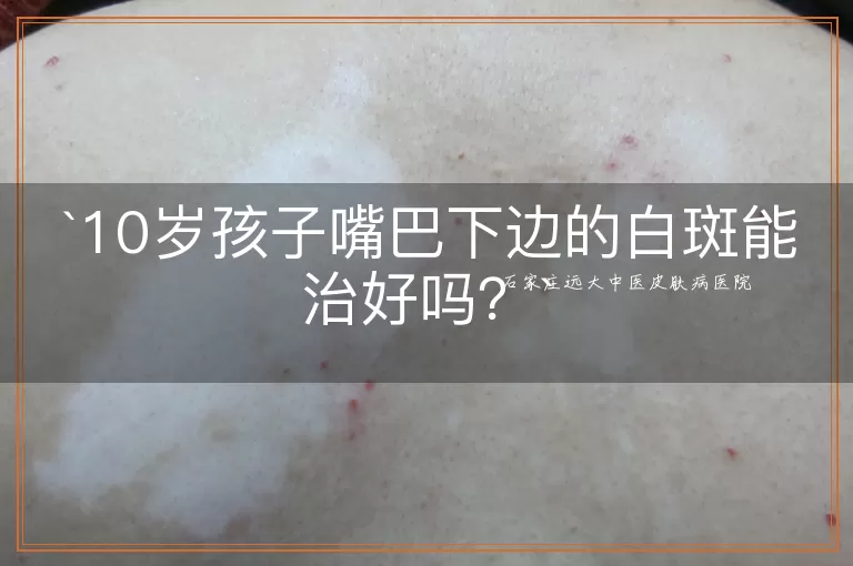 10岁孩子嘴巴下边的白斑能治好吗？
