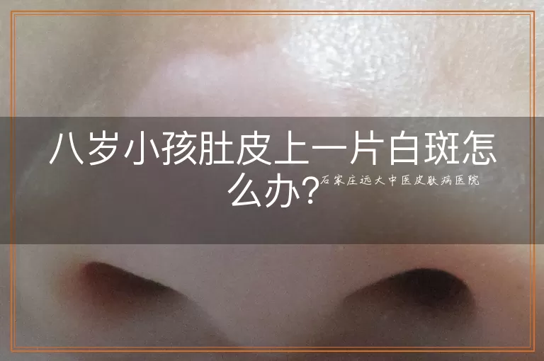 八岁小孩肚皮上一片白斑怎么办?
