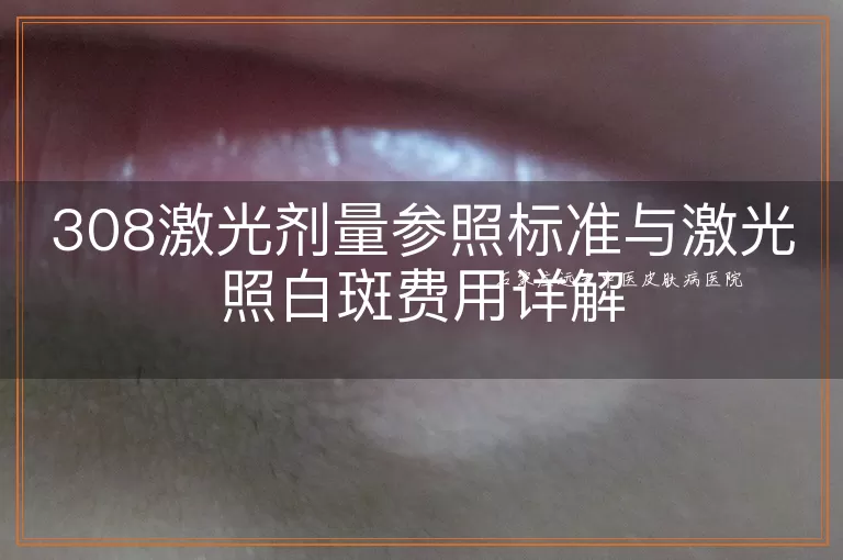 308激光剂量参照标准与激光照白斑费用详解