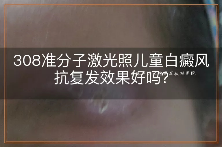 308准分子激光照儿童白癜风抗复发效果好吗?