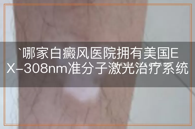 哪家白癜风医院拥有美国EX-308nm准分子激光治疗系统?