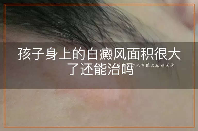 孩子身上的白癜风面积很大了还能治吗