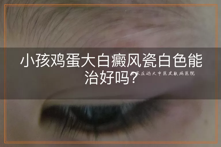 小孩鸡蛋大白癜风瓷白色能治好吗？