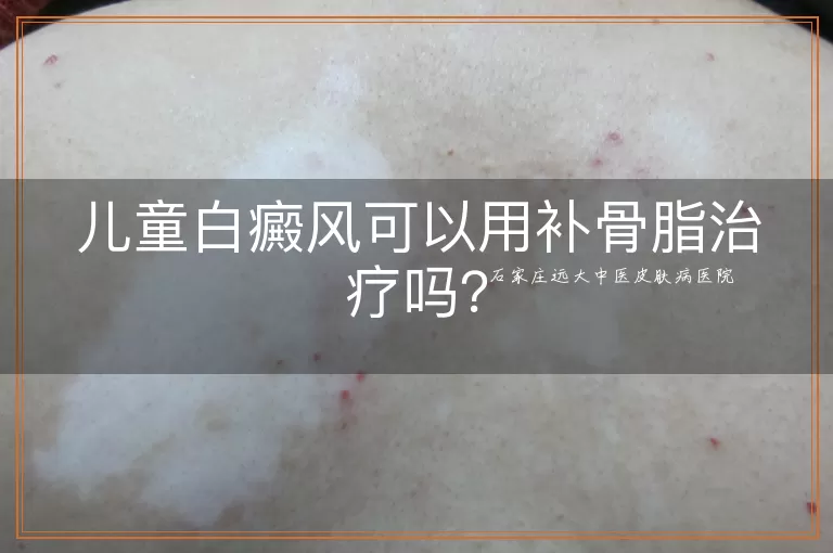 儿童白癜风可以用补骨脂治疗吗？