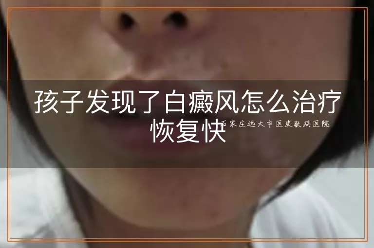 孩子发现了白癜风怎么治疗恢复快