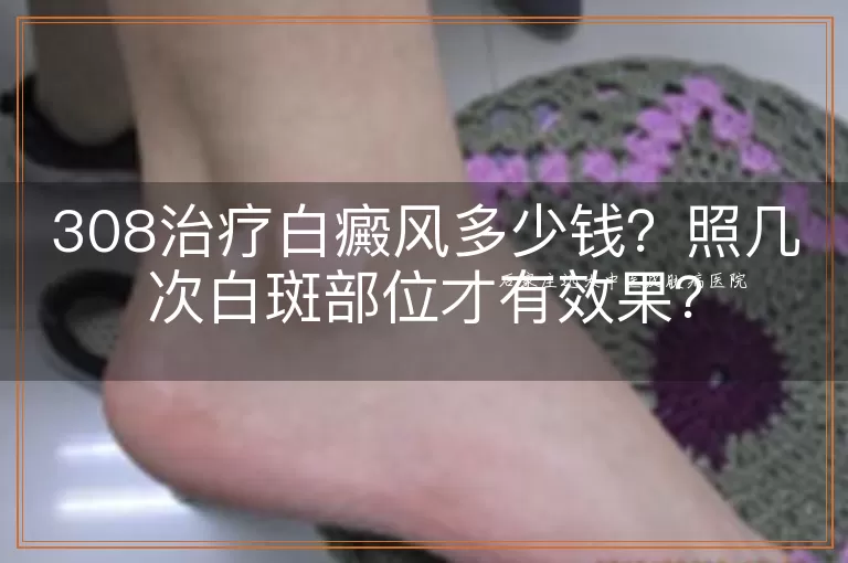308治疗白癜风多少钱？照几次白斑部位才有效果？