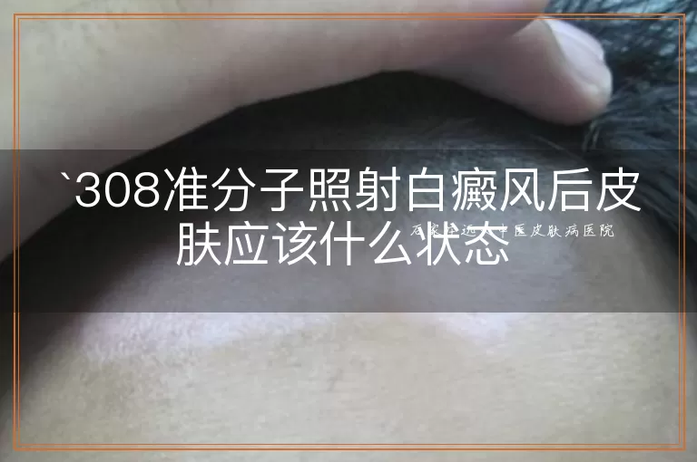 308准分子照射白癜风后皮肤应该什么状态