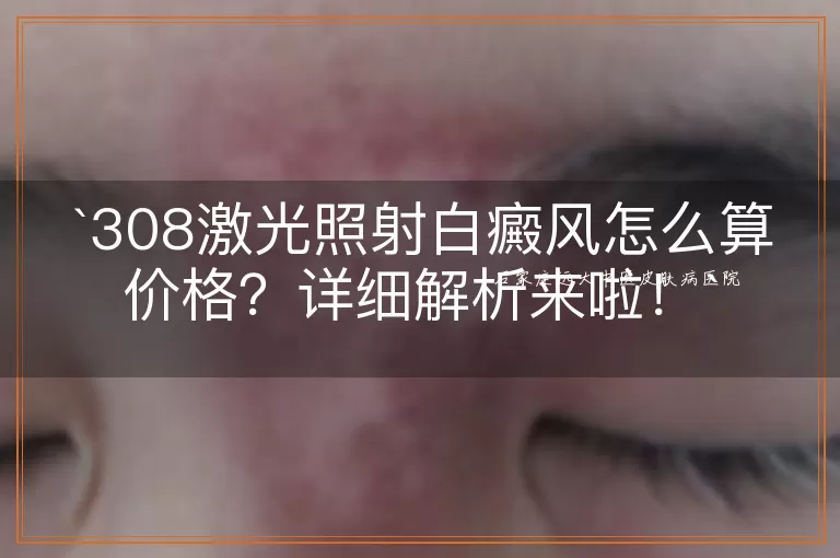 308激光照射白癜风怎么算价格？详细解析来啦！