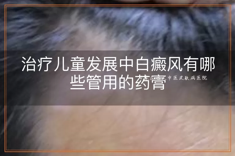 治疗儿童发展中白癜风有哪些管用的药膏