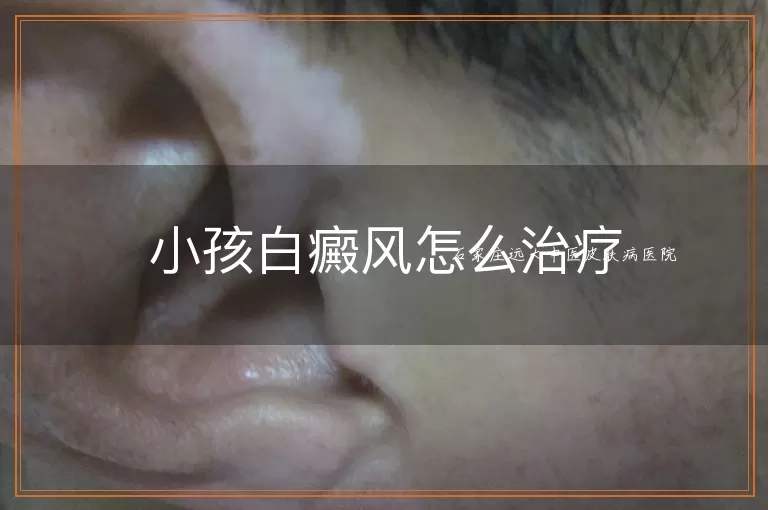 小孩白癜风怎么治疗