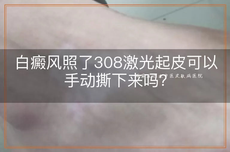 白癜风照了308激光起皮可以手动撕下来吗？
