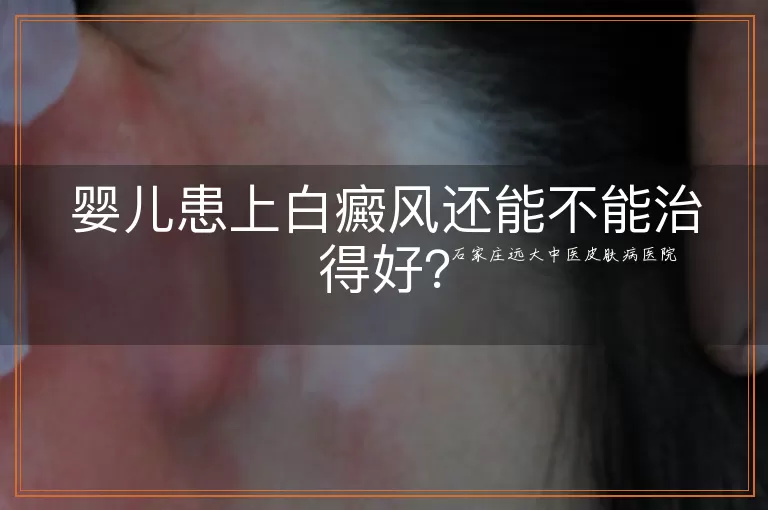 婴儿患上白癜风还能不能治得好?