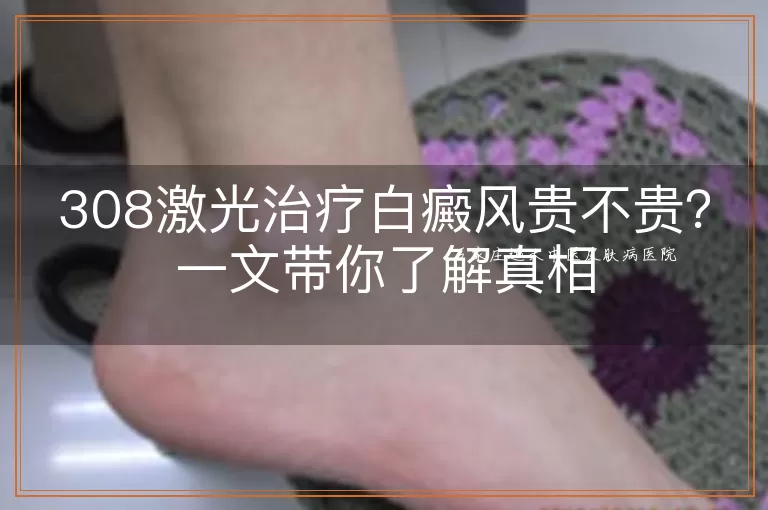 308激光治疗白癜风贵不贵？一文带你了解真相