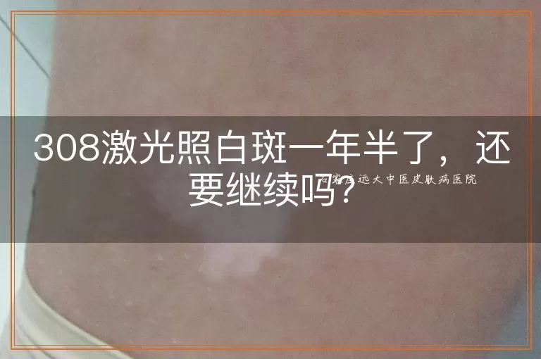 308激光照白斑一年半了，还要继续吗？