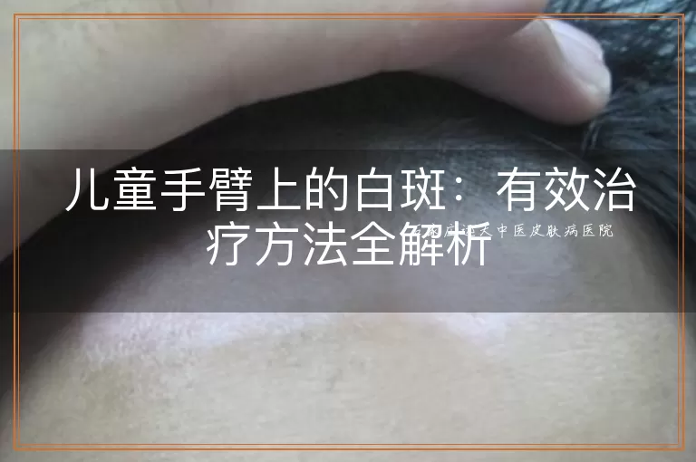 儿童手臂上的白斑：有效治疗方法全解析