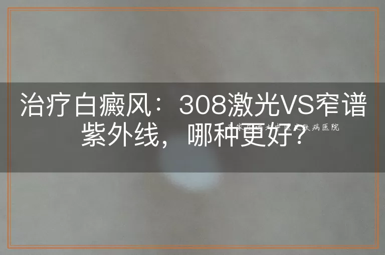 治疗白癜风：308激光VS窄谱紫外线，哪种更好？