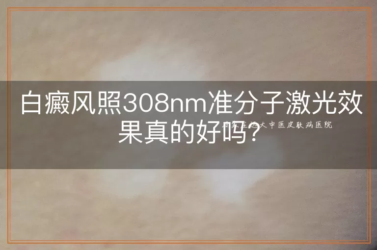 白癜风照308nm准分子激光效果真的好吗？