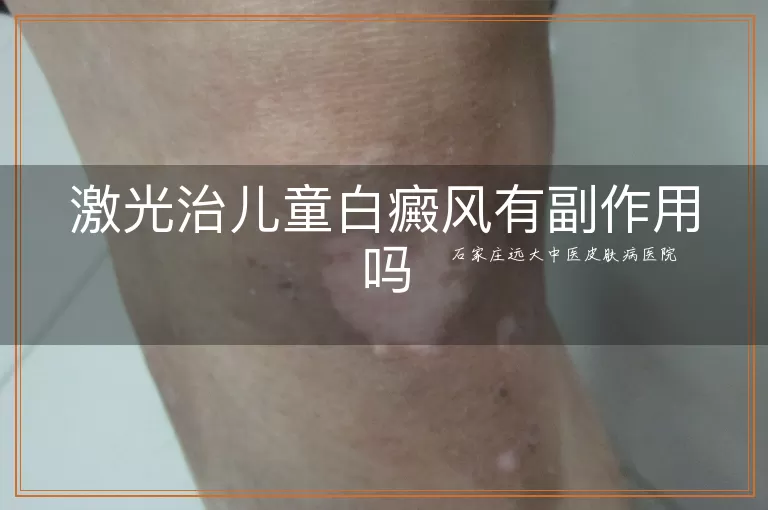 激光治儿童白癜风有副作用吗