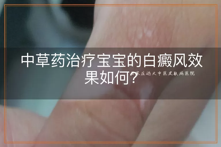 中草药治疗宝宝的白癜风效果如何？