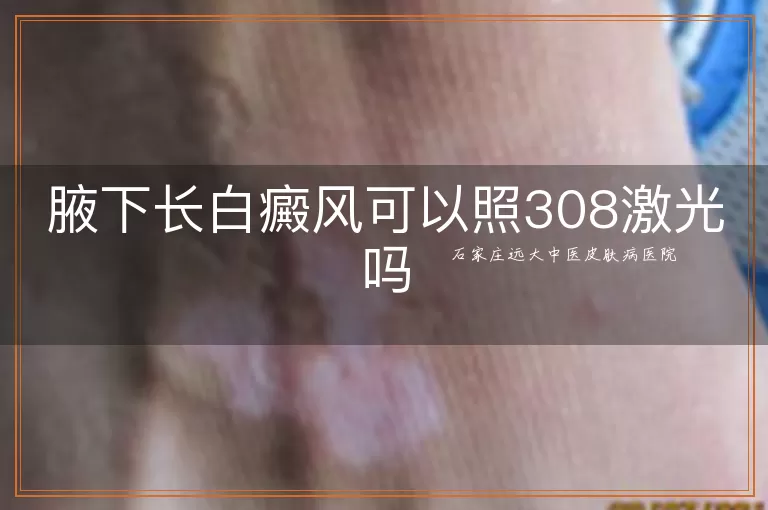 腋下长白癜风可以照308激光吗