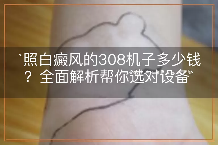 照白癜风的308机子多少钱?全面解析帮你选对设备