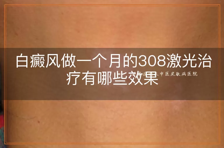 白癜风做一个月的308激光治疗有哪些效果
