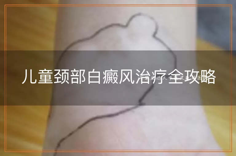 儿童颈部白癜风治疗全攻略