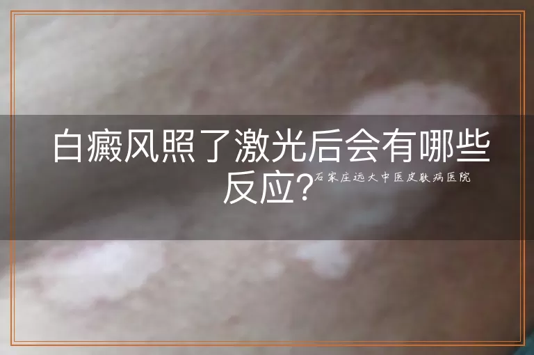 白癜风照了激光后会有哪些反应？