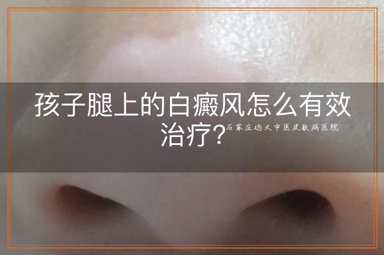 孩子腿上的白癜风怎么有效治疗？