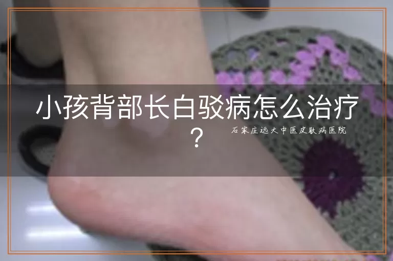 小孩背部长白驳病怎么治疗？