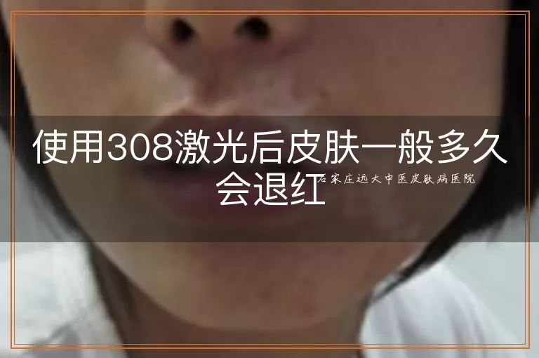 使用308激光后皮肤一般多久会退红