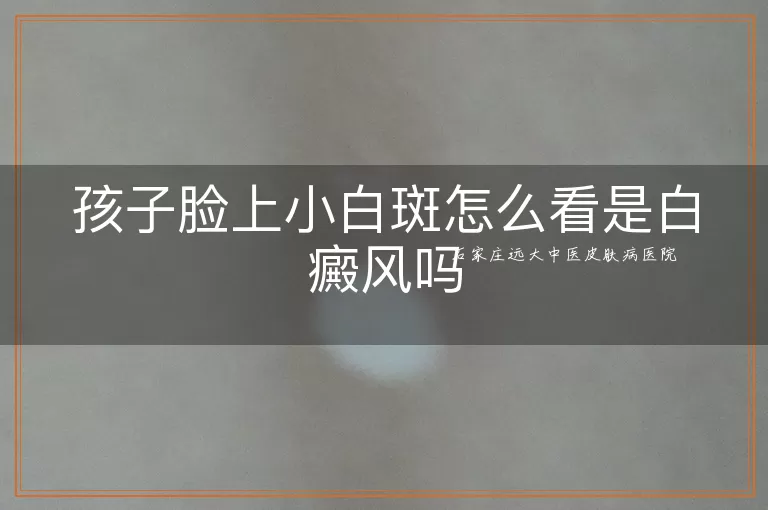 孩子脸上小白斑怎么看是白癜风吗