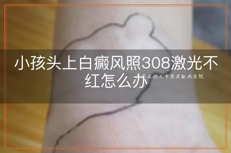 小孩头上白癜风照308激光不红怎么办