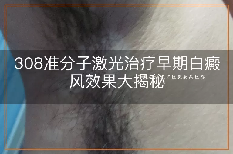 308准分子激光治疗早期白癜风效果大揭秘