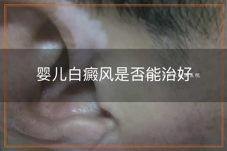 婴儿白癜风是否能治好