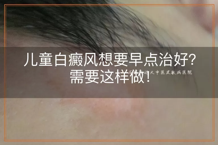 儿童白癜风想要早点治好？需要这样做！