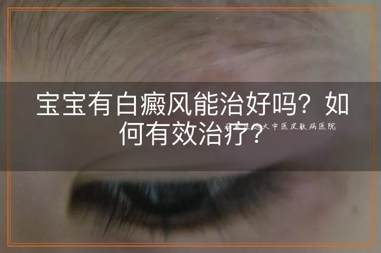 宝宝有白癜风能治好吗？如何有效治疗？