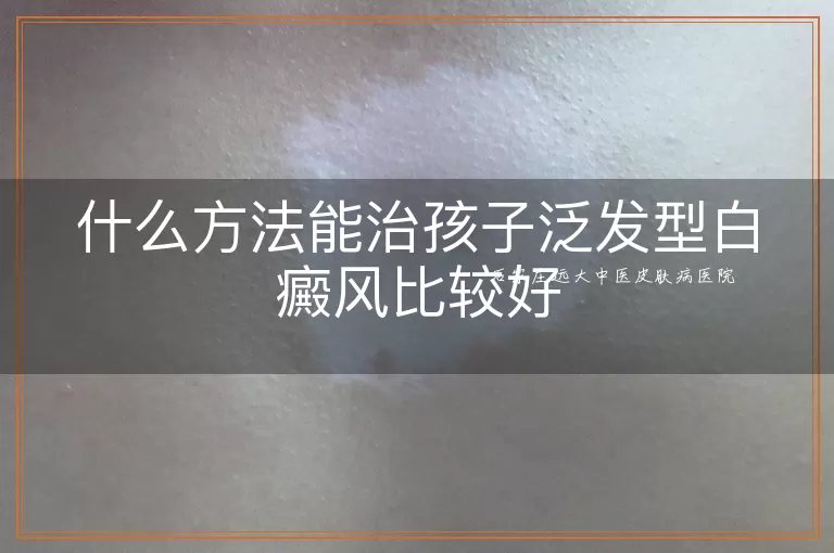 什么方法能治孩子泛发型白癜风比较好