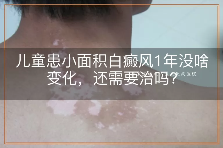 儿童患小面积白癜风1年没啥变化,还需要治吗?