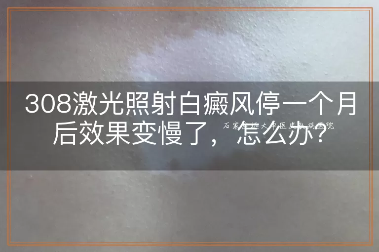 308激光照射白癜风停一个月后效果变慢了,怎么办?