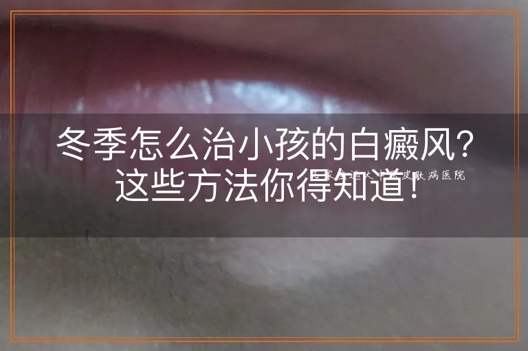 冬季怎么治小孩的白癜风?这些方法你得知道!