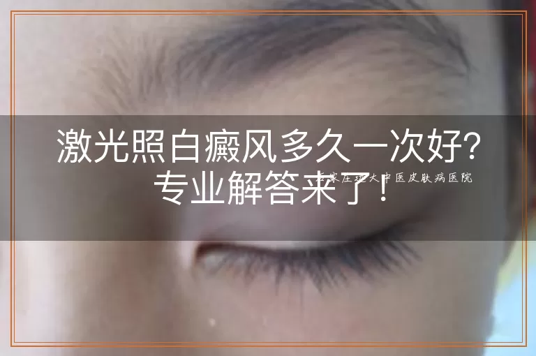 激光照白癜风多久一次好？专业解答来了！