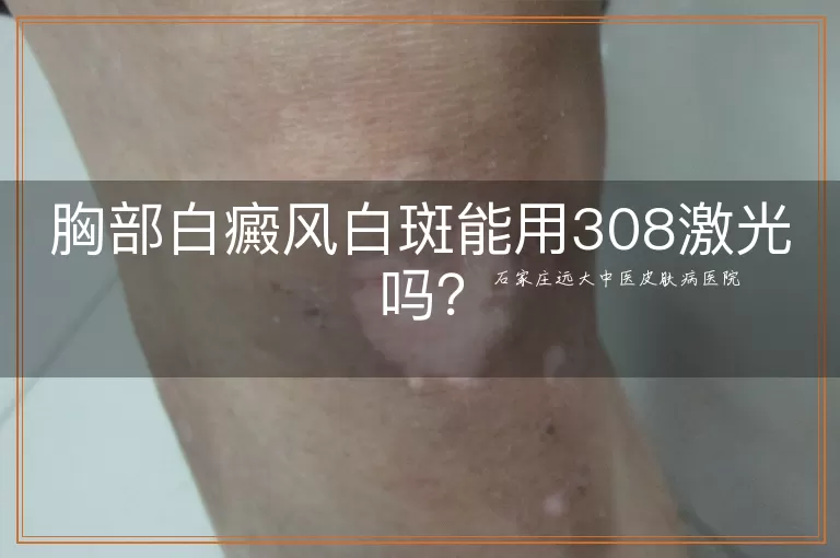胸部白癜风白斑能用308激光吗？
