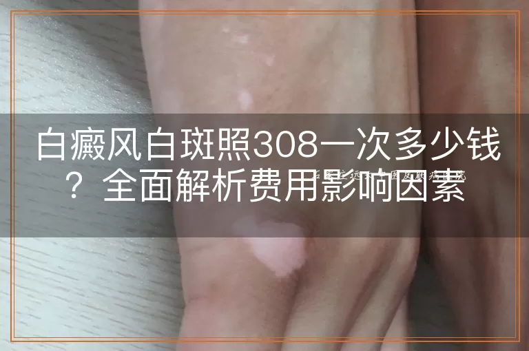 白癜风白斑照308一次多少钱?全面解析费用影响因素